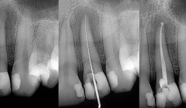 x-rays of a tooth before, during, and after root canal